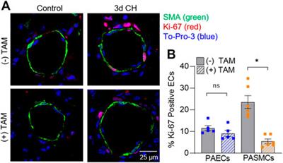 Smooth muscle Acid-sensing ion channel 1a as a therapeutic target to reverse hypoxic pulmonary hypertension